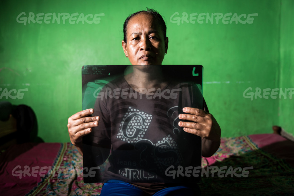50 year-old Munjiah holds an X-Ray of her chest showing specks strongly suspected to be coal dust in her lungs at her home in Cilacap, Central Java, Indonesia. She was diagnosed with chronic obstructive pulmonary disease. According to a health survey carried out by Greenpeace in August 2008, 80% of the people living around the coal plant suffered from respiratory diseases believed to be caused by coal dust.